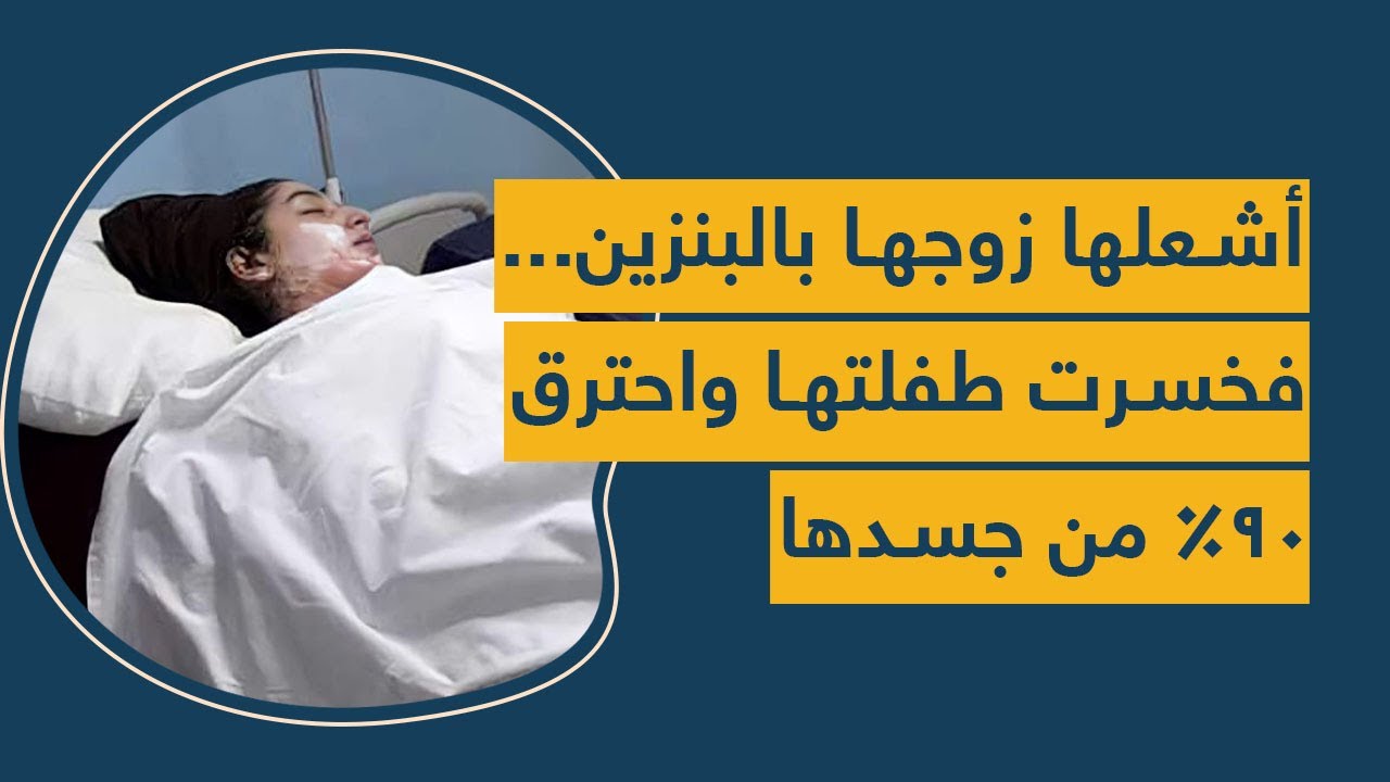 أشعلها زوجها بالبنزين...  فخسرت طفلتها واحترق ٩٠% من جسدها