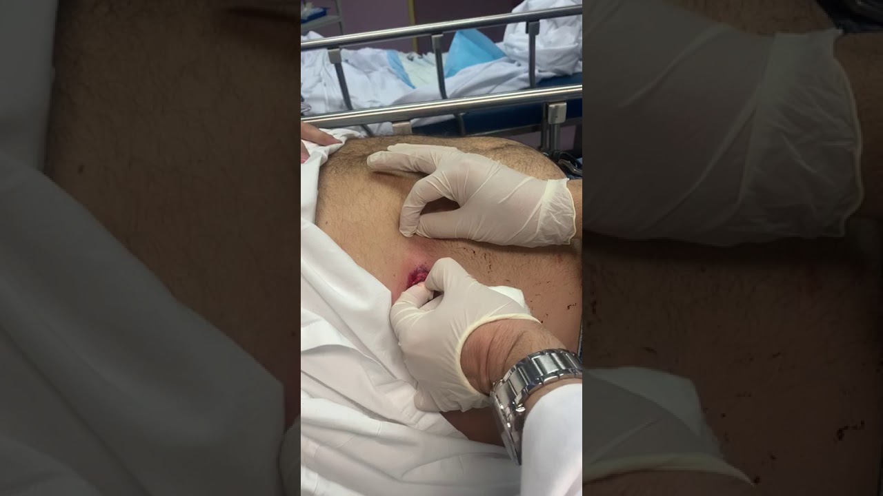 باستخراج طلقة مطاطية من أحد المتظاهرين المصابين